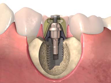 Имплантация зубов: этапы, преимущества, особенности