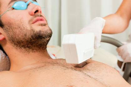 Мужская лазерная эпиляция: особенности процедуры